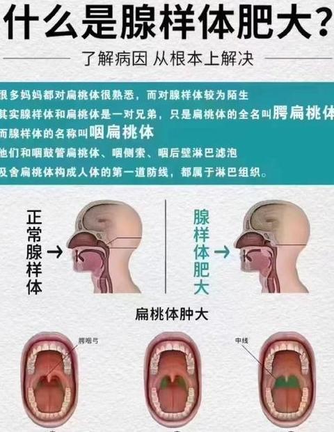 腺样体与扁桃体：区分及育儿注意事项
